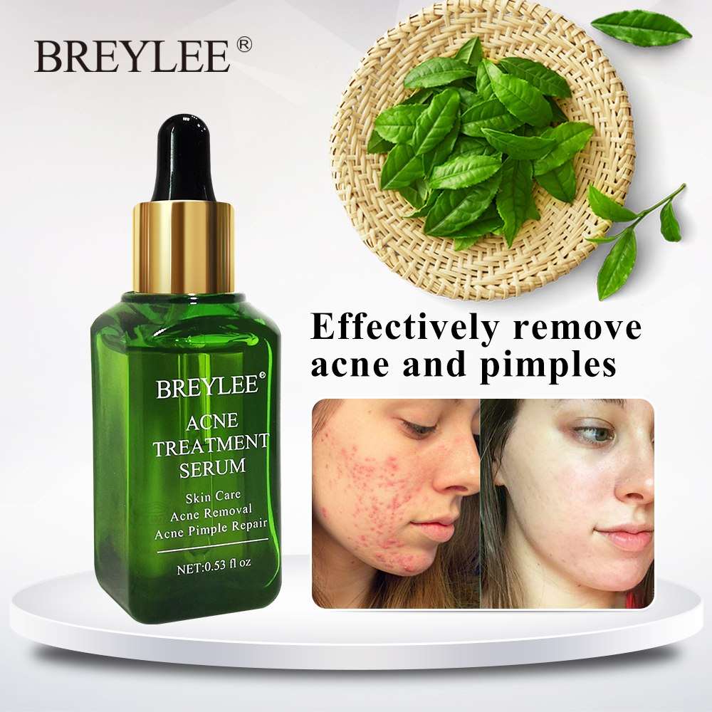 BREYLEE Acne Treatment Serum - Your Ultimate Solution for Clear, Radiant Skin