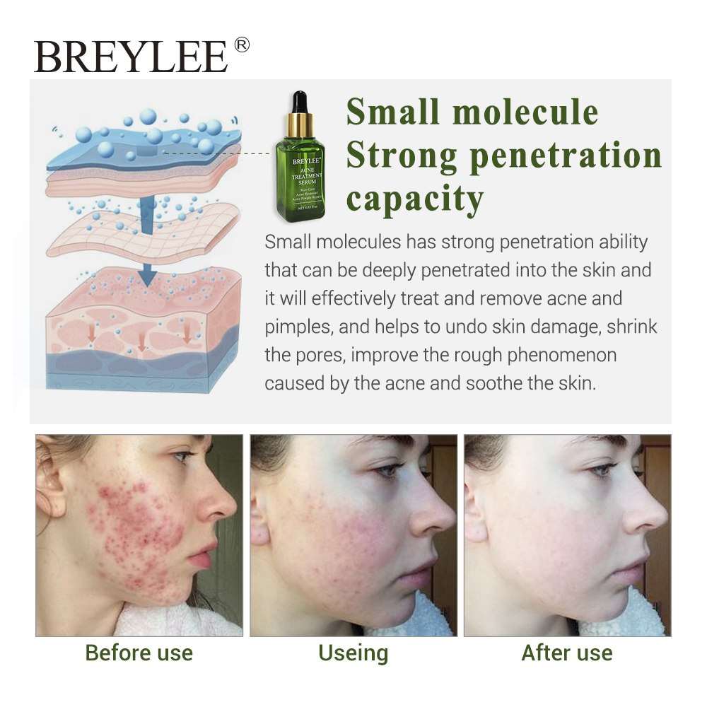BREYLEE Acne Treatment Serum - Your Ultimate Solution for Clear, Radiant Skin